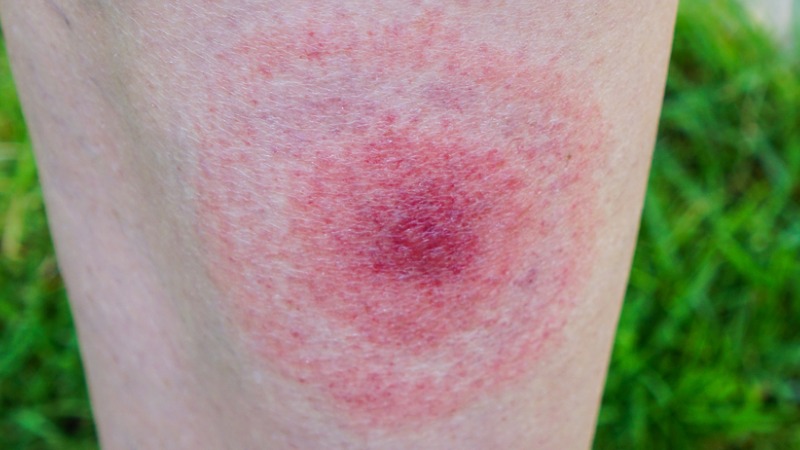 huidafwijking erythema migrans ziekte van Lyme